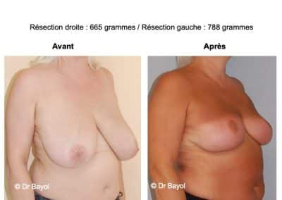 hypertrophie mammaire Annecy